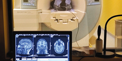 العلاج الصوتي غير الجراحي يعزز الآمال في علاج ألزهايمر 