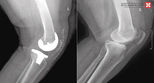 بعد ساعات من عملية استبدال مفصل ركبة 